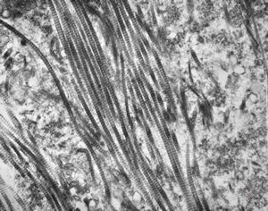 F, 45y. | necrobiosis lipoidica F, 45y. | necrobiosis lipoidica